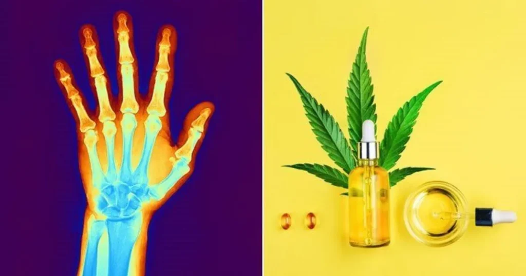 Come il CBD può aiutare con i sintomi dell'artrite